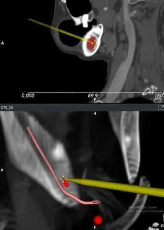 RETINA-Nova software - Nerve & Vessel Delineation
