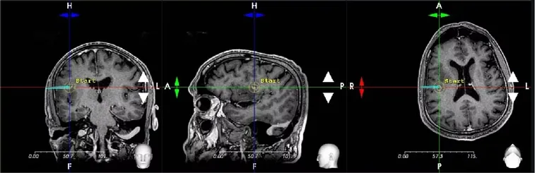 RETINA-Nova software - Surgical Path Planning