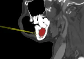 RETINA-Nova software - Segmentation